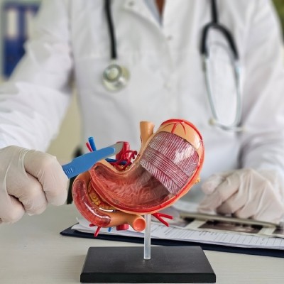 Avantages d’une chirurgie SASI bypass à Charleroi
