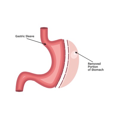 Déroulement d’une sleeve gastrectomie à Charleroi